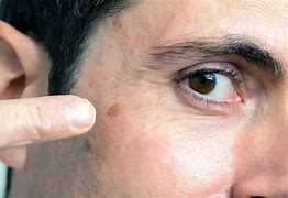 Image result for What Does Skin Cancer Look Like