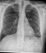 Image result for Solitary Pulmonary Nodule NCCN