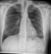 Image result for Solitary Nodule of Lung 6Cm