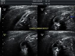 Image result for Meningocele Ultrasound