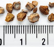Image result for 2Mm Black Kidney Stone