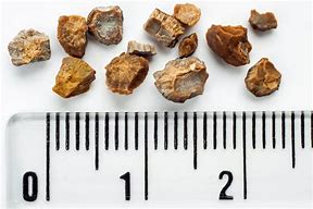 Image result for What Does a 7Mm Kidney Stone Look Like