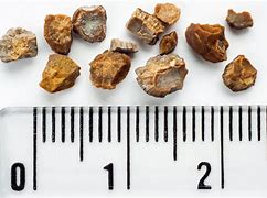 Image result for Human Kidney Stones