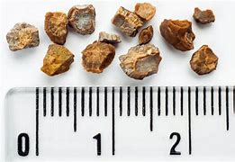 Image result for 9Mm Kidney Stone
