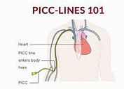 Image result for PICC Line Catheter Measurement