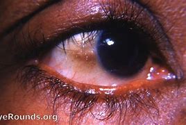 Image result for Trichomoniasis in Eye