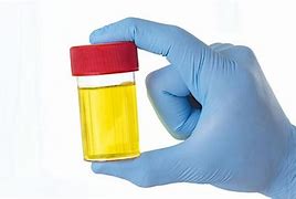 Image result for Urine Test Hypervolemia