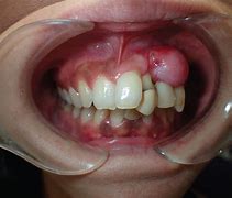 Image result for Gingival Mass