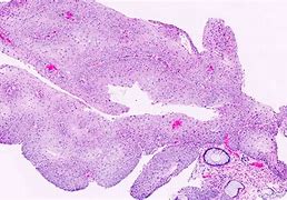 Image result for Condyloma Acuminatum Pathology