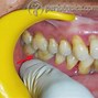 Image result for Gum Fistula From Tooth Abscess