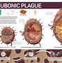 Image result for Bubonic Plague Lymph Nodes