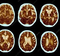 Image result for Alzheimer Brain CT Scan