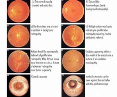 Image result for Diabetic Retinopathy Exudates