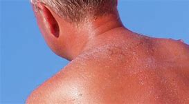 Image result for SunBurn On Dark Skin