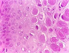 Image result for Molluscum Contagiosum Histology Image