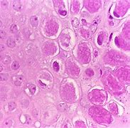 Image result for Molluscum Contagiosum Histology