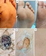 Image result for Wart Treatment Injection