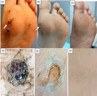 Image result for Wart Treatment Injection
