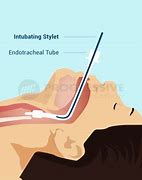 Image result for Anesthesia Stylet