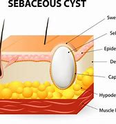 Image result for Sebaceous Cyst Burst