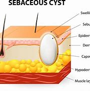 Image result for Sebaceous Cyst