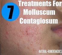 Image result for Molluscum Baby