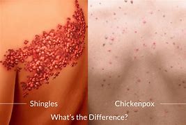 Image result for Shingles Pox