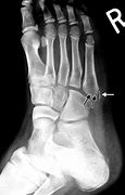 Image result for Broken Ankle Signs