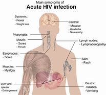 Image result for What Does HIV Mouth Sores Look Like