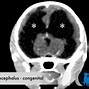 Image result for Hydrocephalus in Dogs