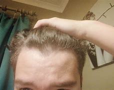 Image result for Hair Thinning Side of Head