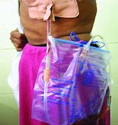 Image result for 4000 Ml Drainage Bag