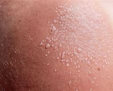 Image result for Sun Blisters On Hands