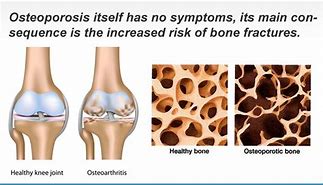 Image result for Osteoporosis Knee