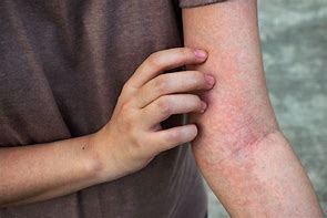 Image result for Skin Rash Under Arms
