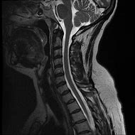 Image result for Mr Spine Cervical without Contrast