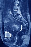 Image result for Uterine Fibroid On CT