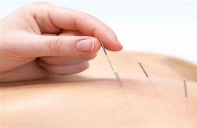 Image result for Acupuncture Needles