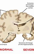 Image result for Dementia Shrinking Brain