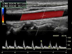 Image result for Carotid Ultrasound Protocol