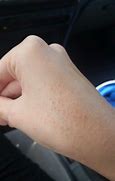 Image result for Skin Bumps On Hands