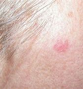 Image result for Skin Cancer On Face Cheek