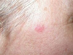 Image result for White Basal Cell Carcinoma