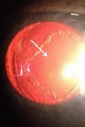 Image result for YAG Laser After Cataract Surgery