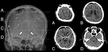 Image result for Brain Metal Electrum