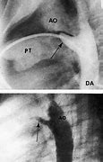 Image result for PDA Congenital Heart Defect