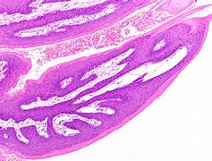 Image result for Squamous Papilloma Skin