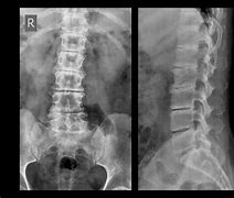 Image result for Lumbar Spine Cancer