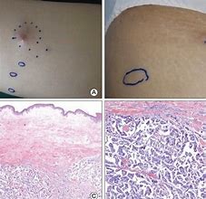 Image result for Ovarium Cancer On Skin