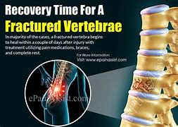 Image result for Lumbar Spine Fracture Treatment